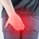 Ambeien (Wasir) Adalah