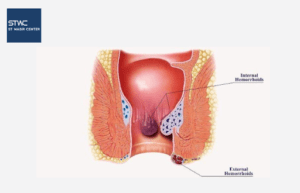 Benjolan Besar di Anus