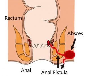 Fistula Ani Penyakit Yang Kambuh Kambuhan