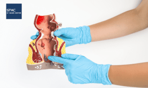 Jenis Ambeien Dalam yang Perlu Diketahui