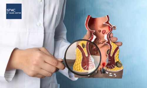 Operasi Ambeien dengan Metode Ultrasonic, Bagaimana Prosedurnya?