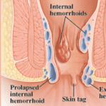 Ambeien Prolaps Parah