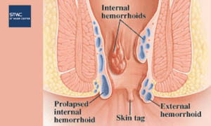 Ambeien Prolaps Parah