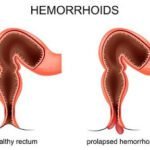 Ambeien Grade Tinggi