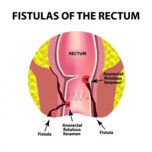 Lubang Anus Fistula Ani