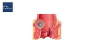 Benjolan di Anus