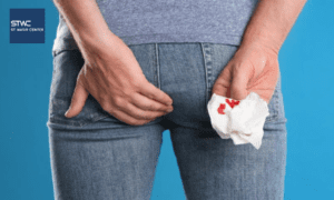 Ambeien Suka Berdarah