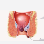Apa itu Ambeien Dalam?