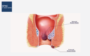 Ciri-ciri Wasir Internal