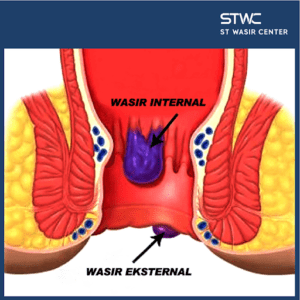 Wasir Internal Stadium Akhir
