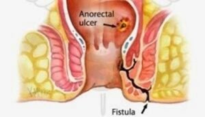Lubang Kecil Dekat Anus
