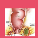 Radang Area Anus