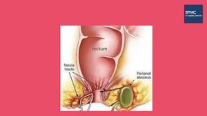 Radang Area Anus