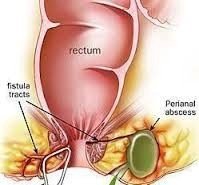 Pengobatan Fistula Dua Lubang