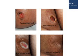 Operasi Fistula Ani dengan FILLAC