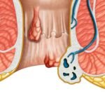 Abses Perianal dan Fistula Ani