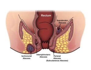 Penyakit Abses Perianal