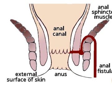 Mengapa Lubang Fistula Tertutup di Bagian Atasnya?