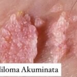 Kutil Kelamin Menularnya Bagaimana?