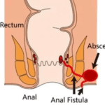 FILAC di STWC untuk Fistula Ani