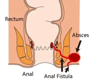 Operasi Fistula Ani dengan Teknik FILAC