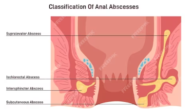 Apa Itu Abses Perianal?