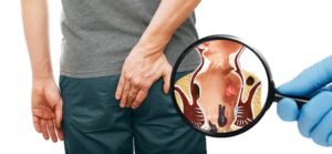 Klinik Ligasi Ambeien Jakarta