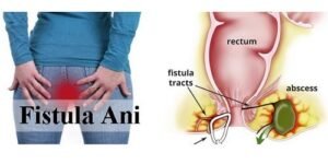 Fistula Ani Keluar Cairan Terus