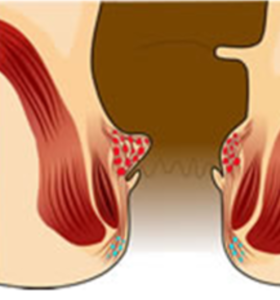 Ambeien Stadium 1 Tanpa Operasi