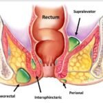 Abses Perianal Berulang Kali