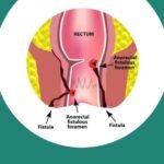 Apa Maksud Fisura Ani?