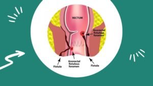 Apa Maksud Fisura Ani?