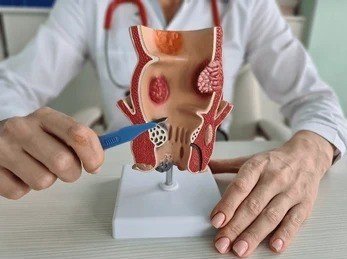 Seluk Beluk Mengenai Wasir yang Wajib Kamu Ketahui