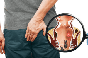 Lubang Anus Nyeri Luar Biasa