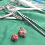 Cara Menghilangkan Ambeien Dalam