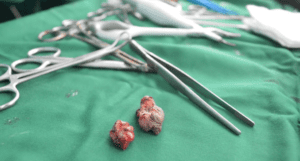 Cara Menghilangkan Ambeien Dalam