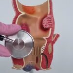 Klinik Fistula Ani Minim Invasif