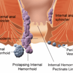 Tanda-tanda Penyakit Ambeien