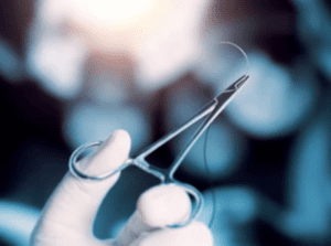 Apakah Operasi Ambeien Perlu Dijahit?