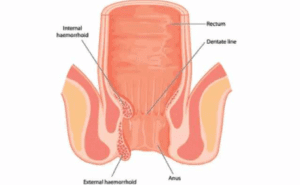Ambeien Dalam Sudah Keluar