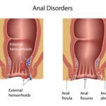 Perbedaan Ambeien dan Fistula Ani