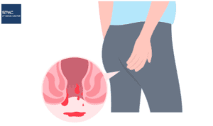 Perdarahan Anus