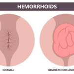 Sembuhin Wasir Pakai Apa?