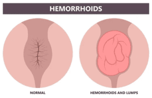 Sembuhin Wasir Pakai Apa?