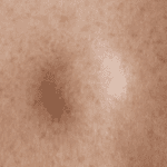 Benjolan di Anus Tapi Tidak Sakit