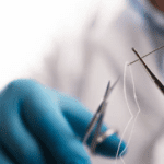 Pengobatan Ambeien Modern Tanpa Jahitan