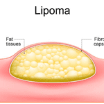 Kenapa Lipoma Bisa Muncul?