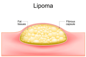 Lipoma Bisa Mengecil Sendiri?