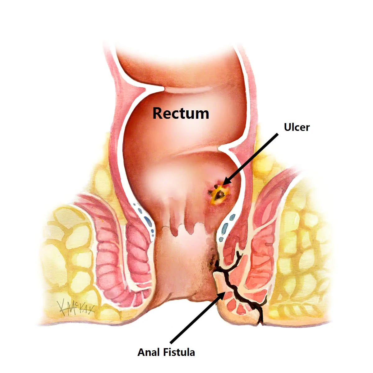 Lubang Fistula Ada Banyak: Apa Penyebab dan Penanganannya?