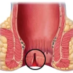 Fisura Ani Perih Banget